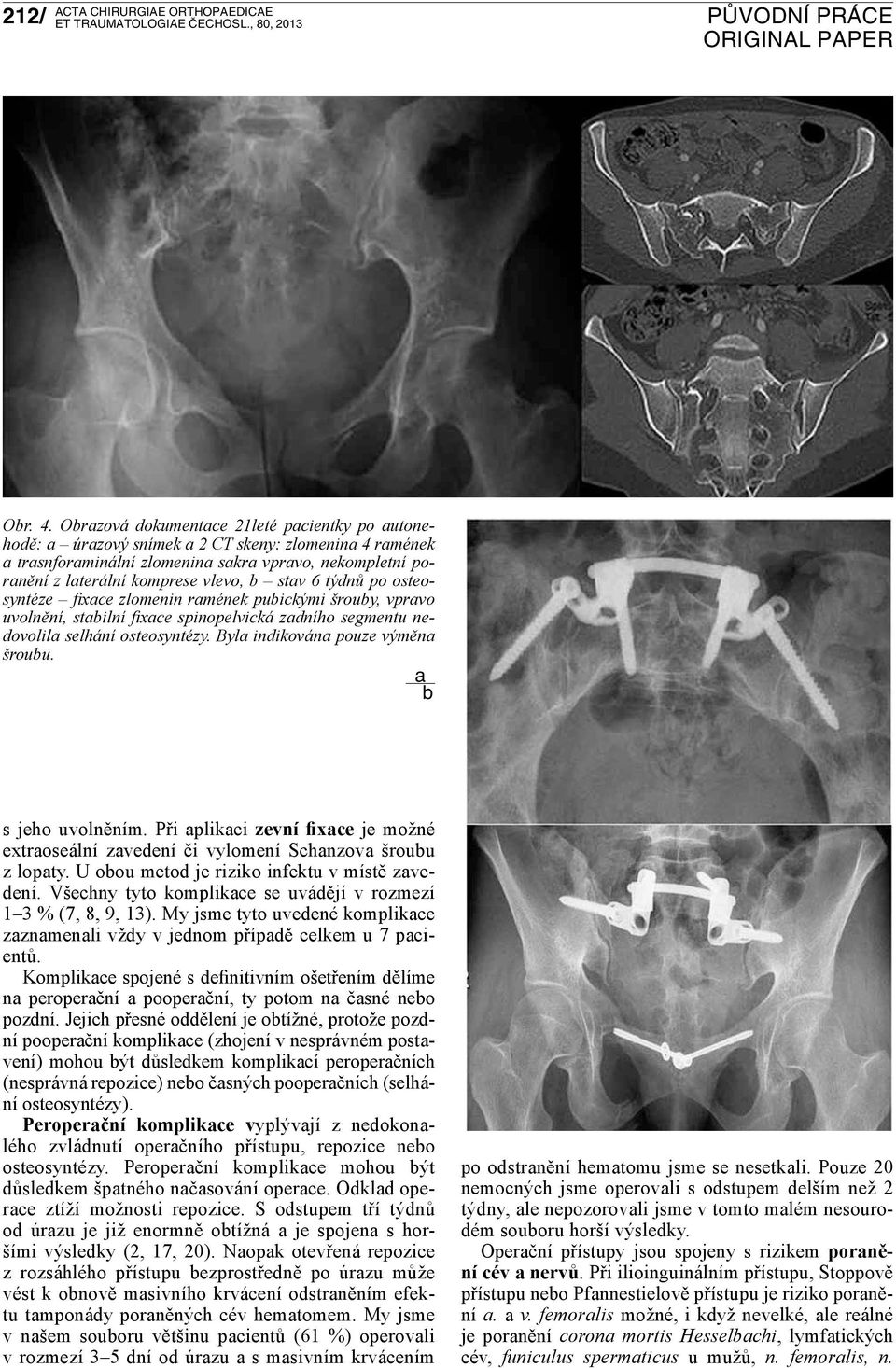 osteosyntéze fixce zlomenin rmének puickými šrouy, vprvo uvolnění, stilní fixce spinopelvická zdního segmentu nedovolil selhání osteosyntézy. Byl indikován pouze výměn šrouu. s jeho uvolněním.