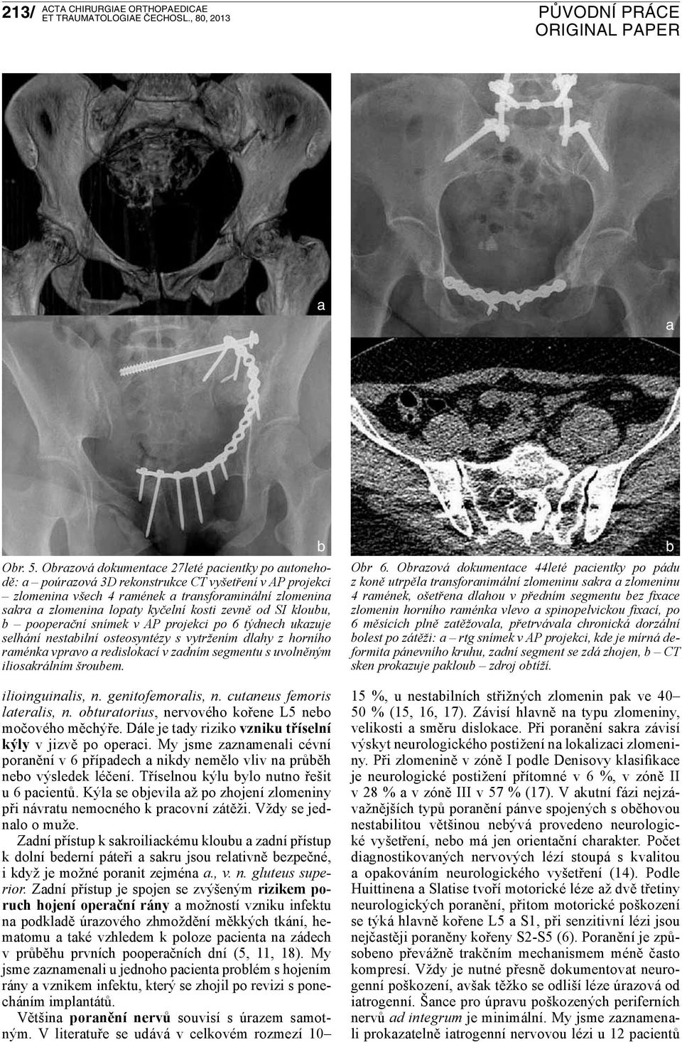 pooperční snímek v AP projekci po 6 týdnech ukzuje selhání nestilní osteosyntézy s vytržením dlhy z horního rménk vprvo redislokcí v zdním segmentu s uvolněným ilioskrálním šrouem. ilioinguinlis, n.