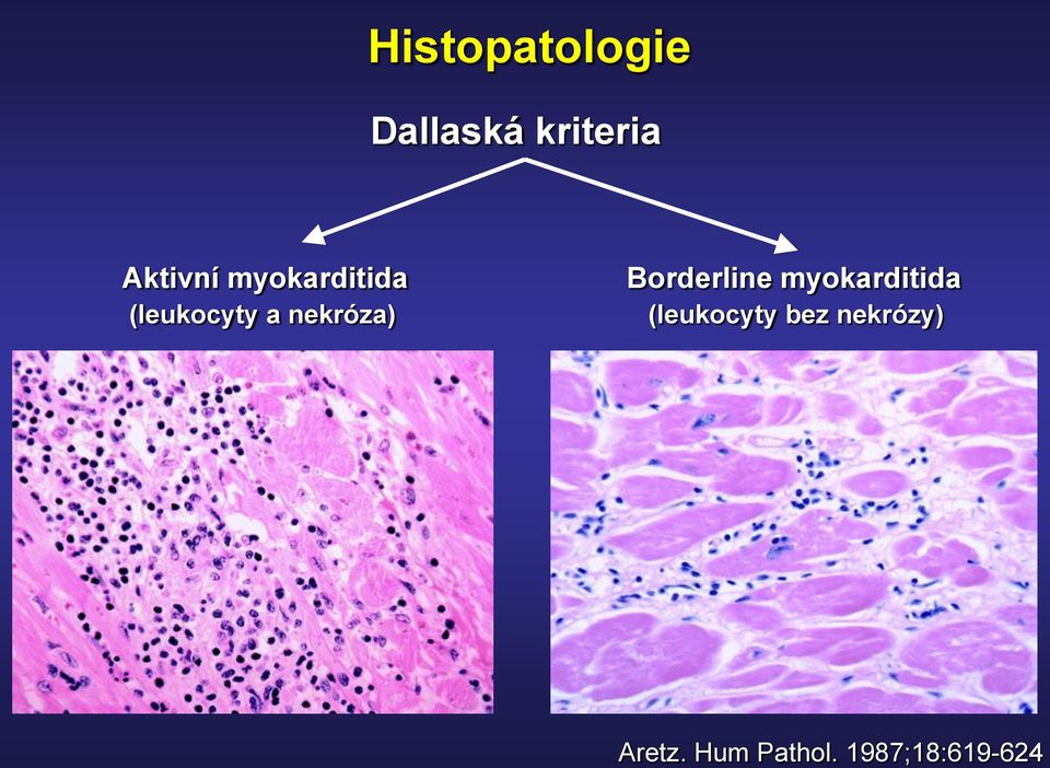 nekróza) Borderline myokarditida