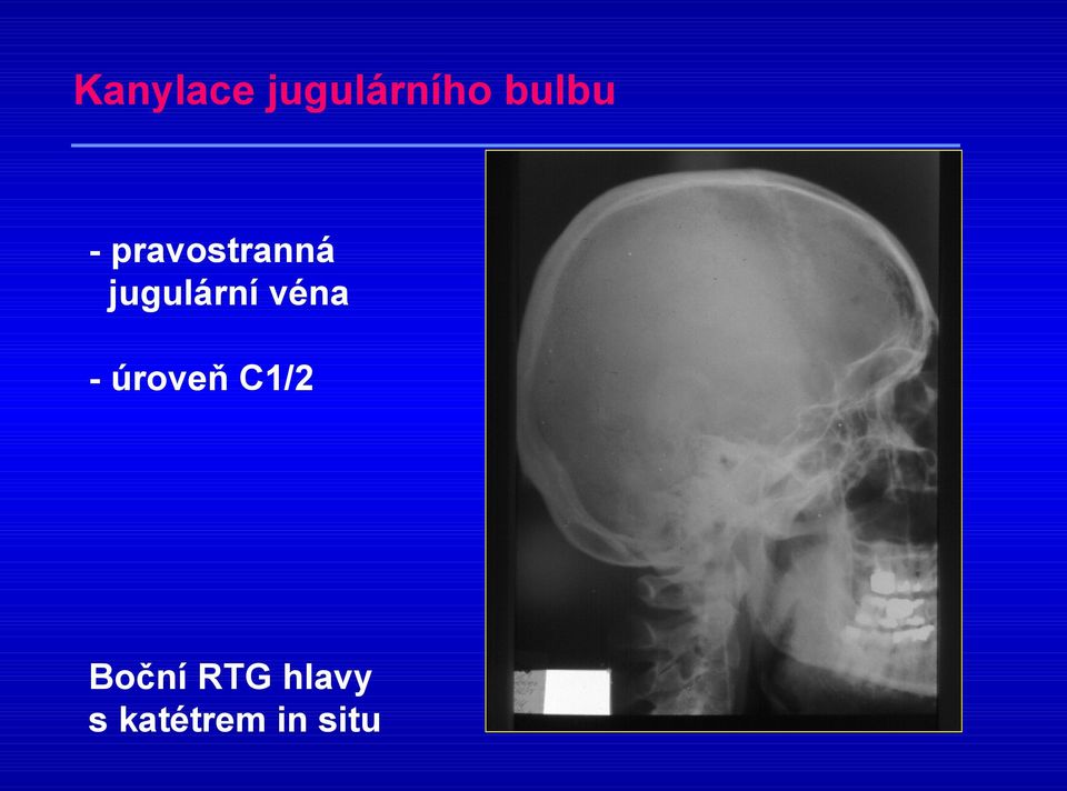 véna - úroveň C1/2 Boční