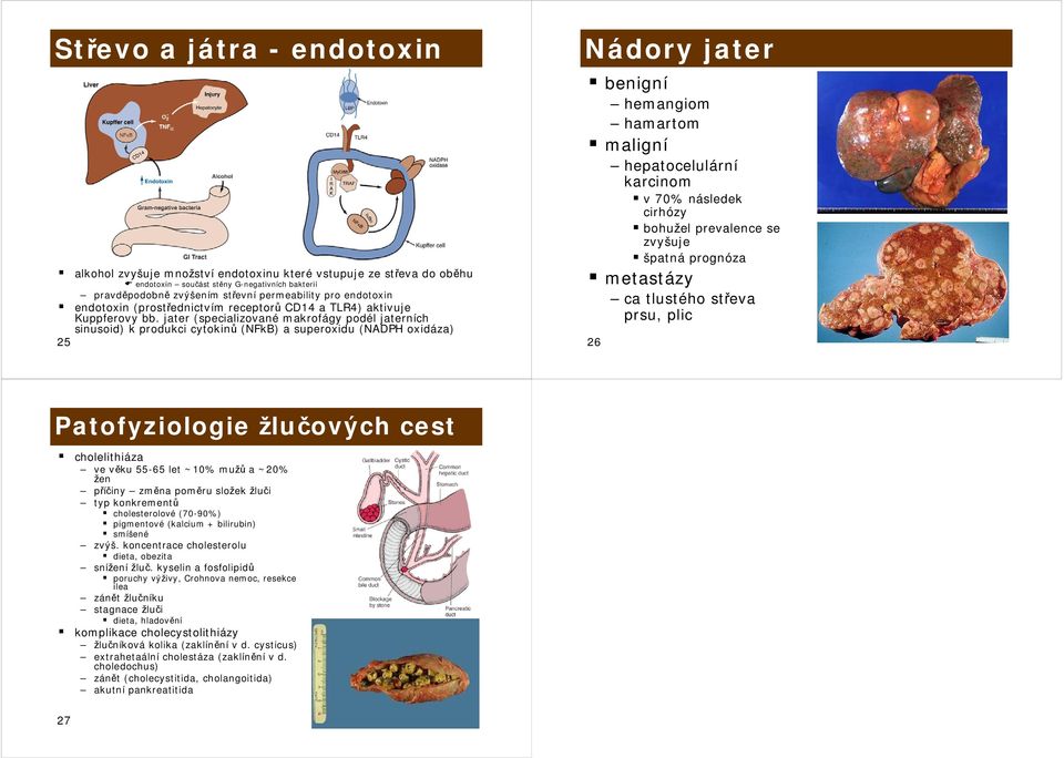 jater (specializované makrofágy podél jaterních sinusoid) k produkci cytokinů (NFkB) a superoxidu (NADPH oxidáza) 25 Nádory jater benigní hemangiom hamartom maligní hepatocelulární karcinom v 70%