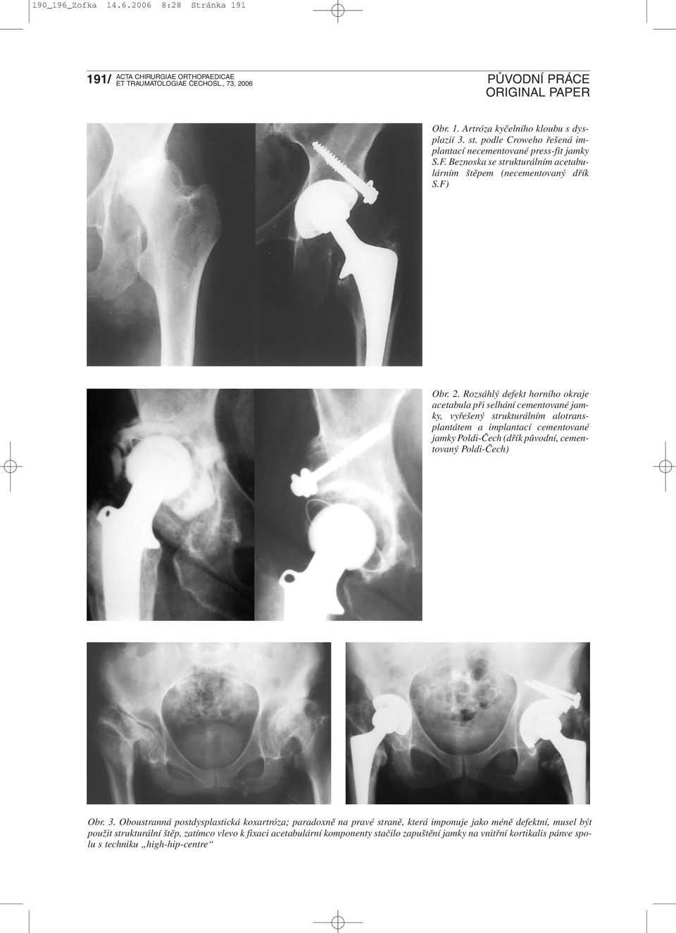 Rozsáhlý defekt horního okraje acetabula při selhání cementované jamky, vyřešený strukturálním alotransplantátem a implantací cementované jamky Poldi-Čech (dřík původní,
