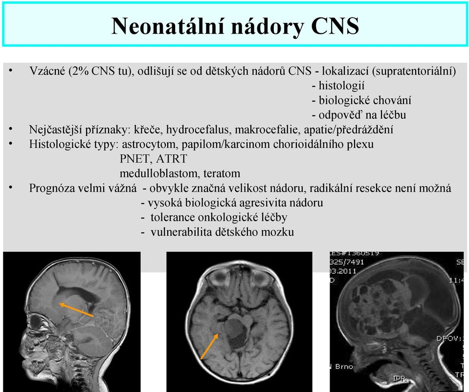 typy: astrocytom, papilom/karcinom chorioidálního plexu PNET, ATRT medulloblastom, teratom Prognóza velmi vážná - obvykle značná