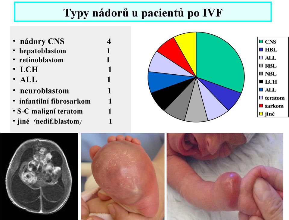 1 1 infantilní fibrosarkom S-C maligní teratom jiné