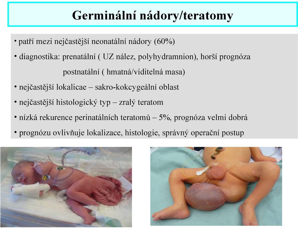 lokalicae sakro-kokcygeální oblast nejčastější histologický typ zralý teratom nízká rekurence