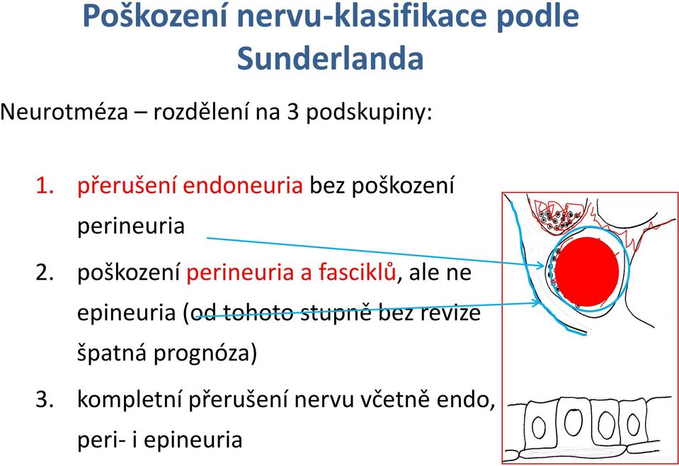 poškození perineuria a fasciklů, ale ne epineuria (od tohoto stupně bez