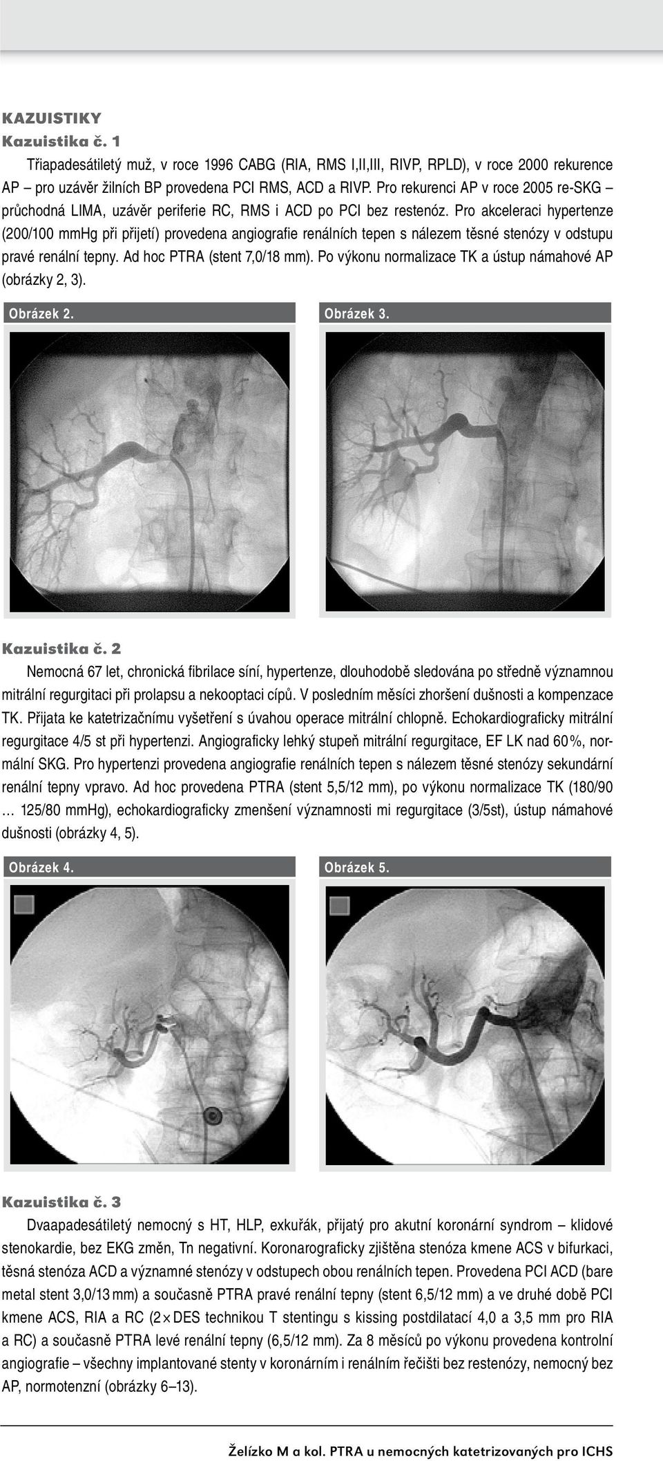 Pro akceleraci hypertenze (200/100 mmhg při přijetí) provedena angiografie renálních tepen s nálezem těsné stenózy v odstupu pravé renální tepny. Ad hoc PTRA (stent 7,0/18 mm).