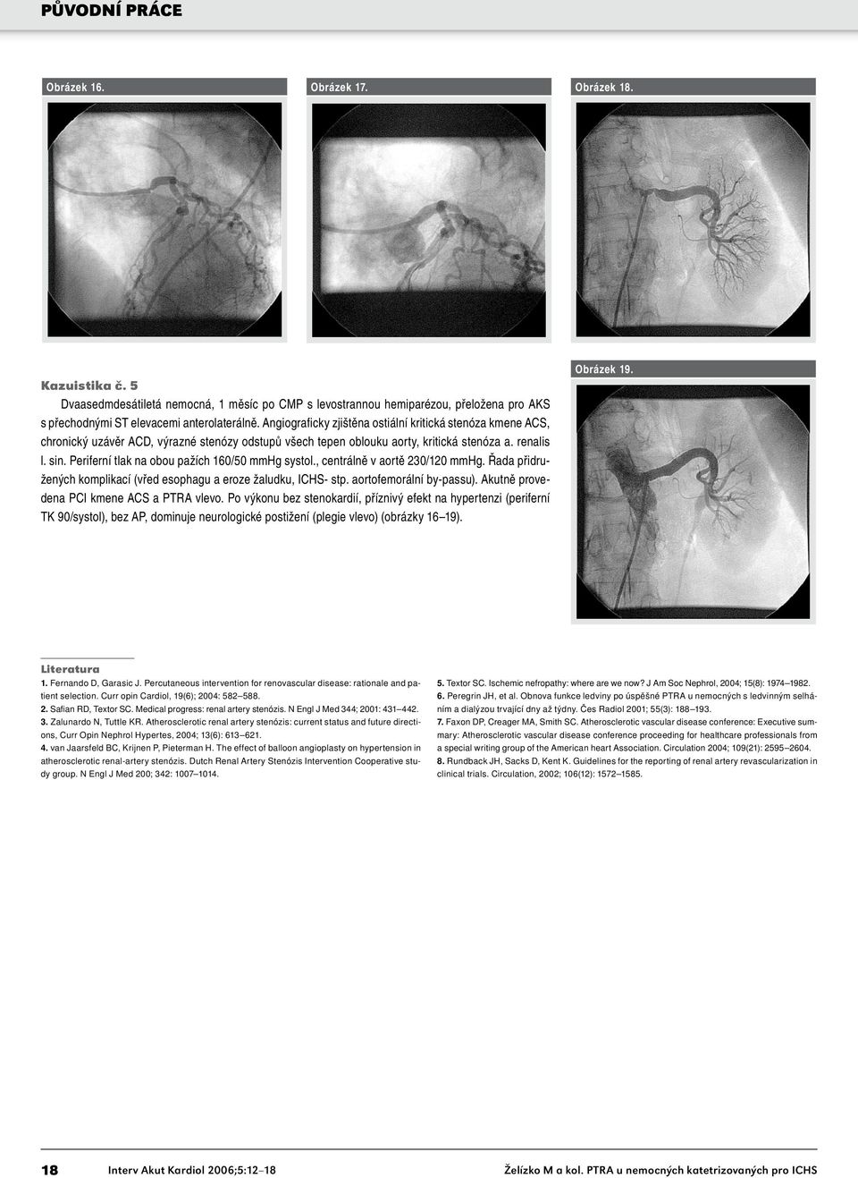 Periferní tlak na obou pažích 160/50 mmhg systol., centrálně v aortě 230/120 mmhg. Řada přidružených komplikací (vřed esophagu a eroze žaludku, ICHS- stp. aortofemorální by-passu).