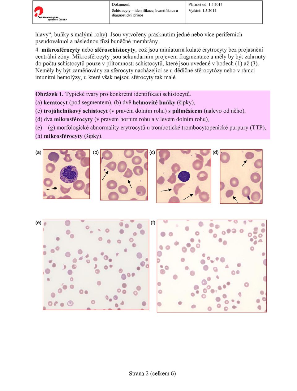 Mikrosférocyty jsou sekundárním projevem fragmentace a měly by být zahrnuty do počtu schistocytů pouze v přítomnosti schistocytů, které jsou uvedené v bodech (1) až (3).