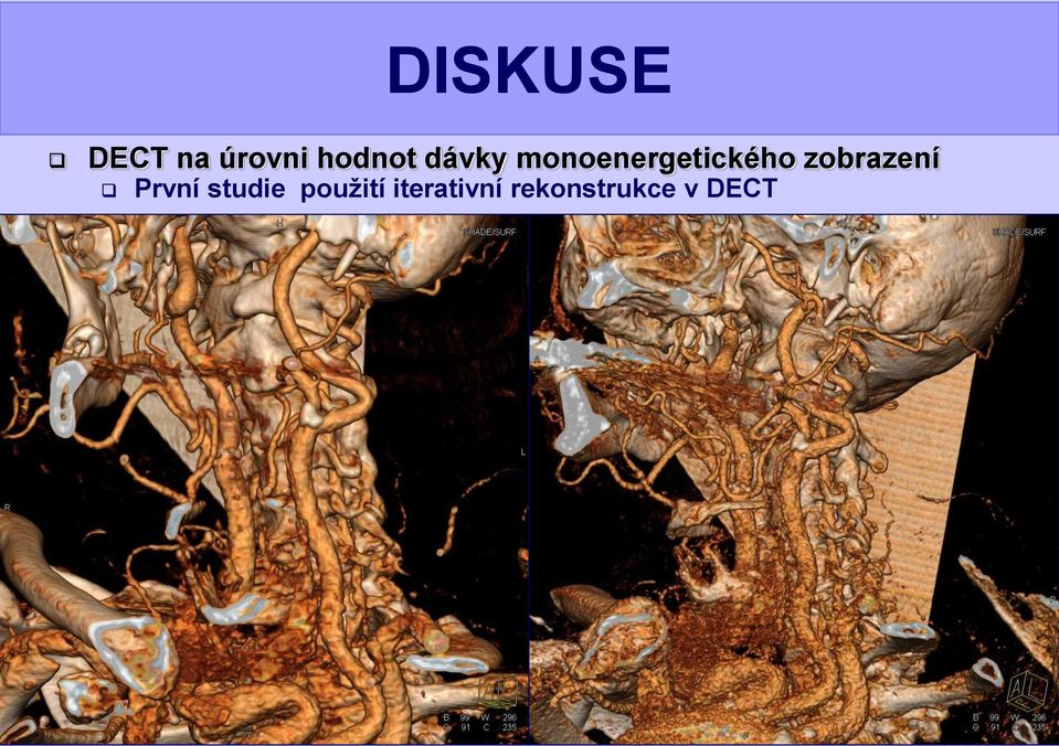 oversamplingu Nemá vliv na výslednou absorpční analýzu Dynamické využití DECT První studie použití iterativní rekonstrukce v DECT