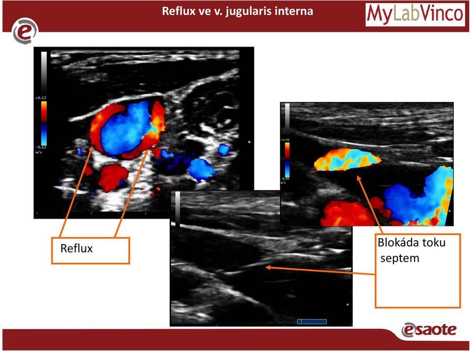 interna Reflux