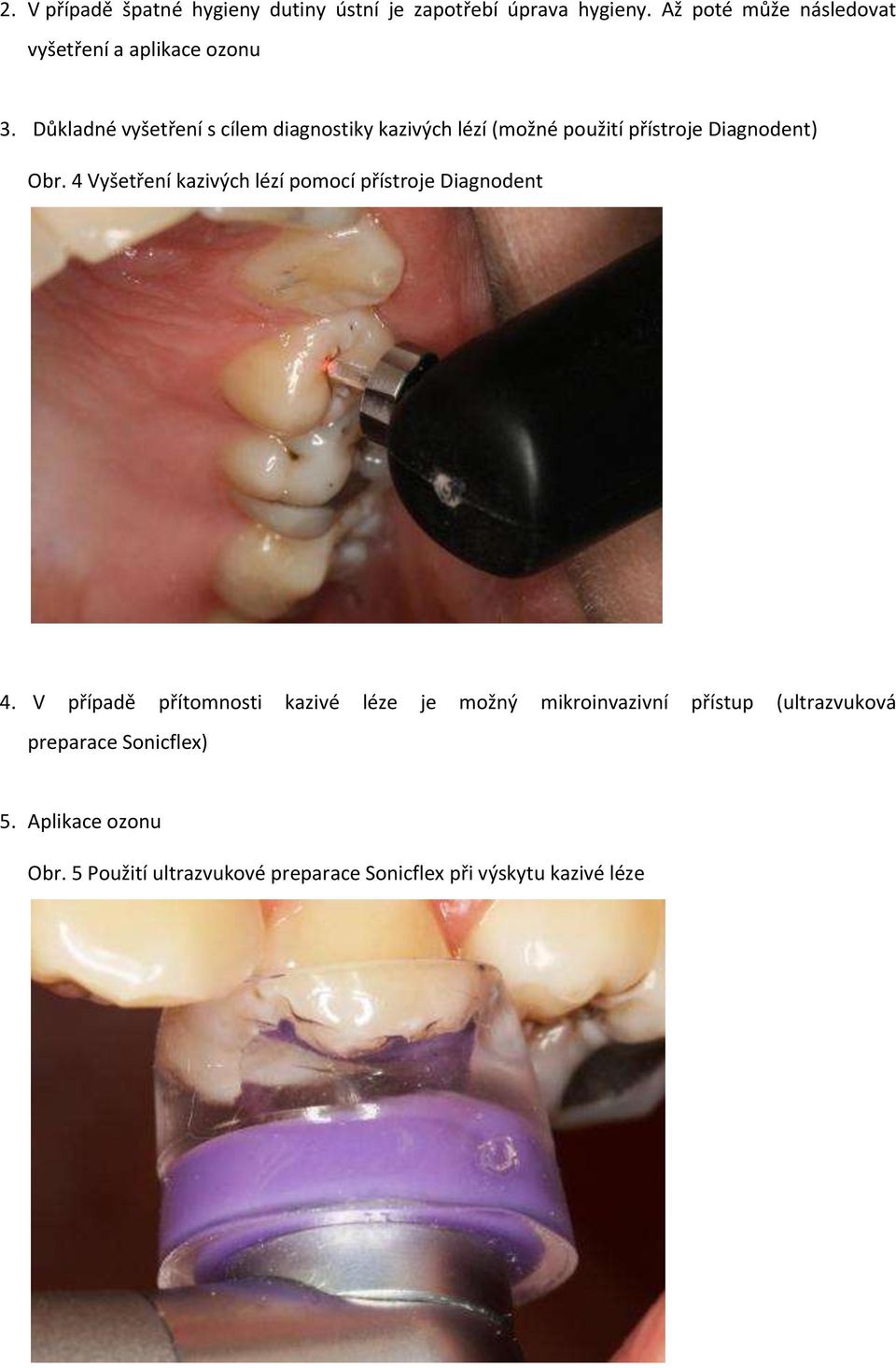 Důkladné vyšetření s cílem diagnostiky kazivých lézí (možné použití přístroje Diagnodent) Obr.