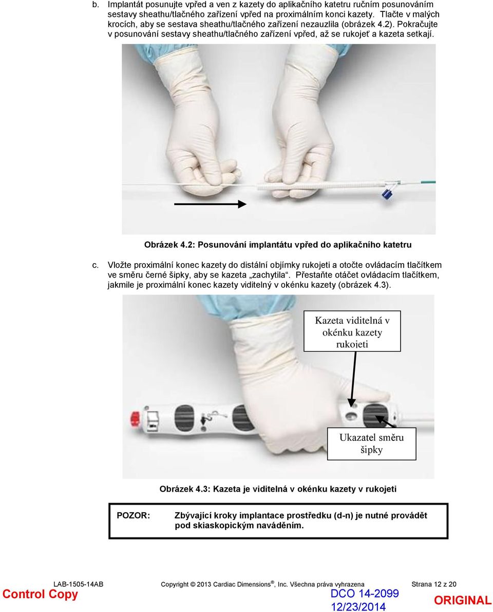 2: Posunování implantátu vpřed do aplikačního katetru c. Vložte proximální konec kazety do distální objímky rukojeti a otočte ovládacím tlačítkem ve směru černé šipky, aby se kazeta zachytila.