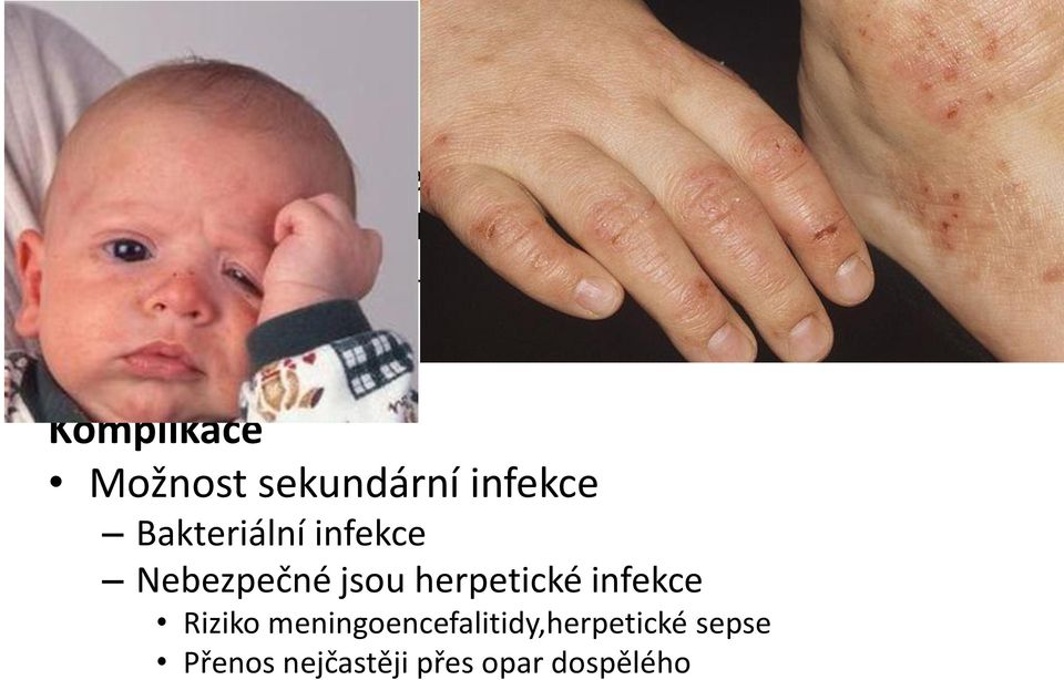 Komplikace Možnost sekundární infekce Bakteriální infekce Nebezpečné jsou