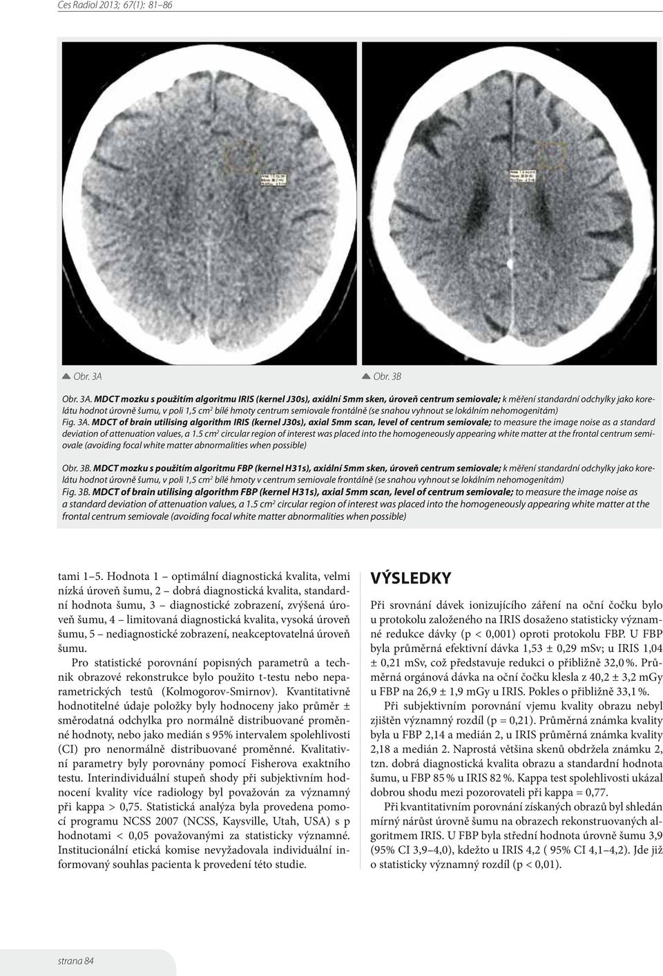 MDCT mozku s použitím algoritmu IRIS (kernel J30s), axiální 5mm sken, úroveň centrum semiovale; k měření standardní odchylky jako korelátu hodnot úrovně šumu, v poli 1,5 cm 2 bílé hmoty centrum