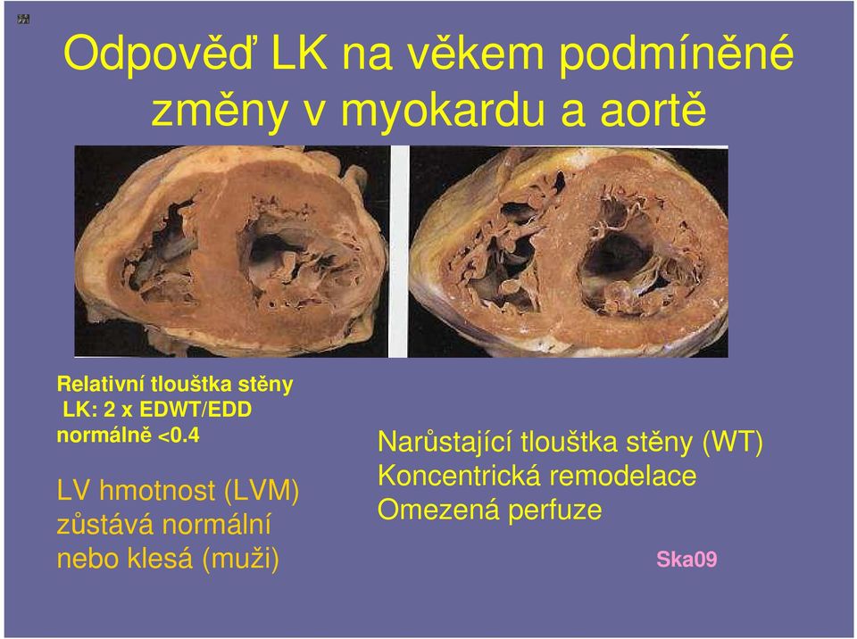 4 LV hmotnost (LVM) zůstává normální nebo klesá (muži)