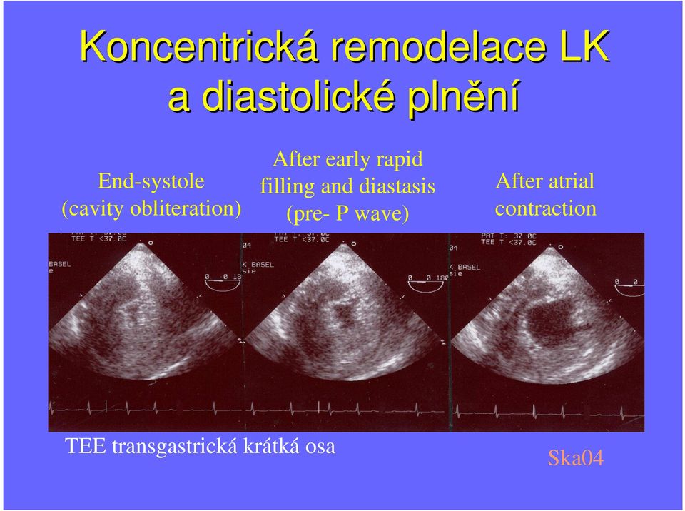 rapid filling and diastasis (pre- P wave) After