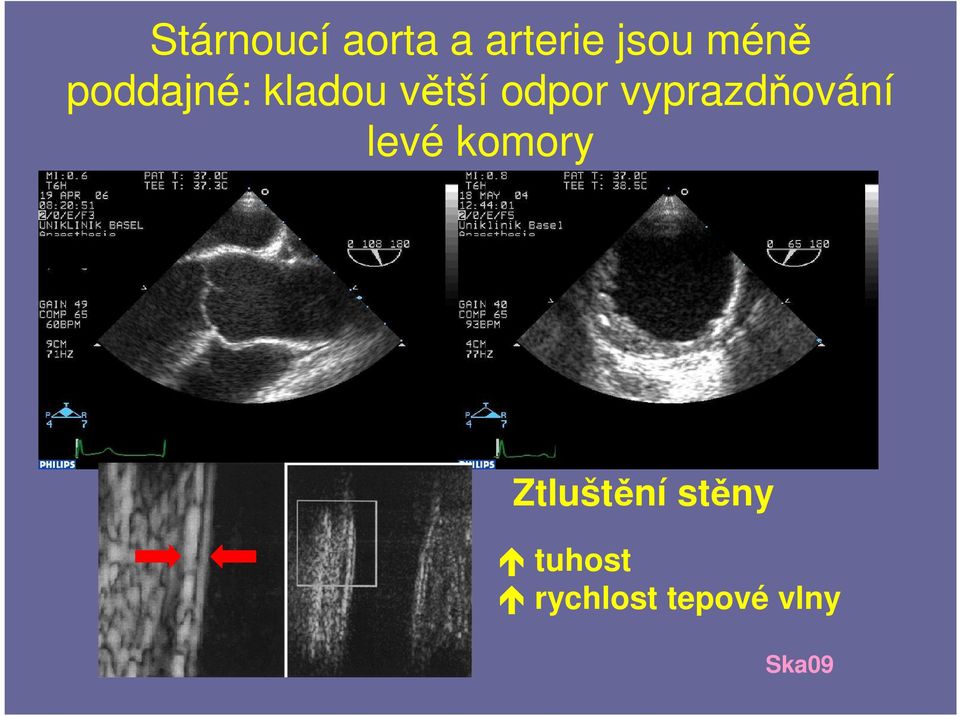 vyprazdňování levé komory