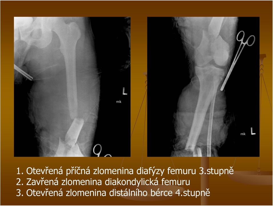 Zavřená zlomenina diakondylická