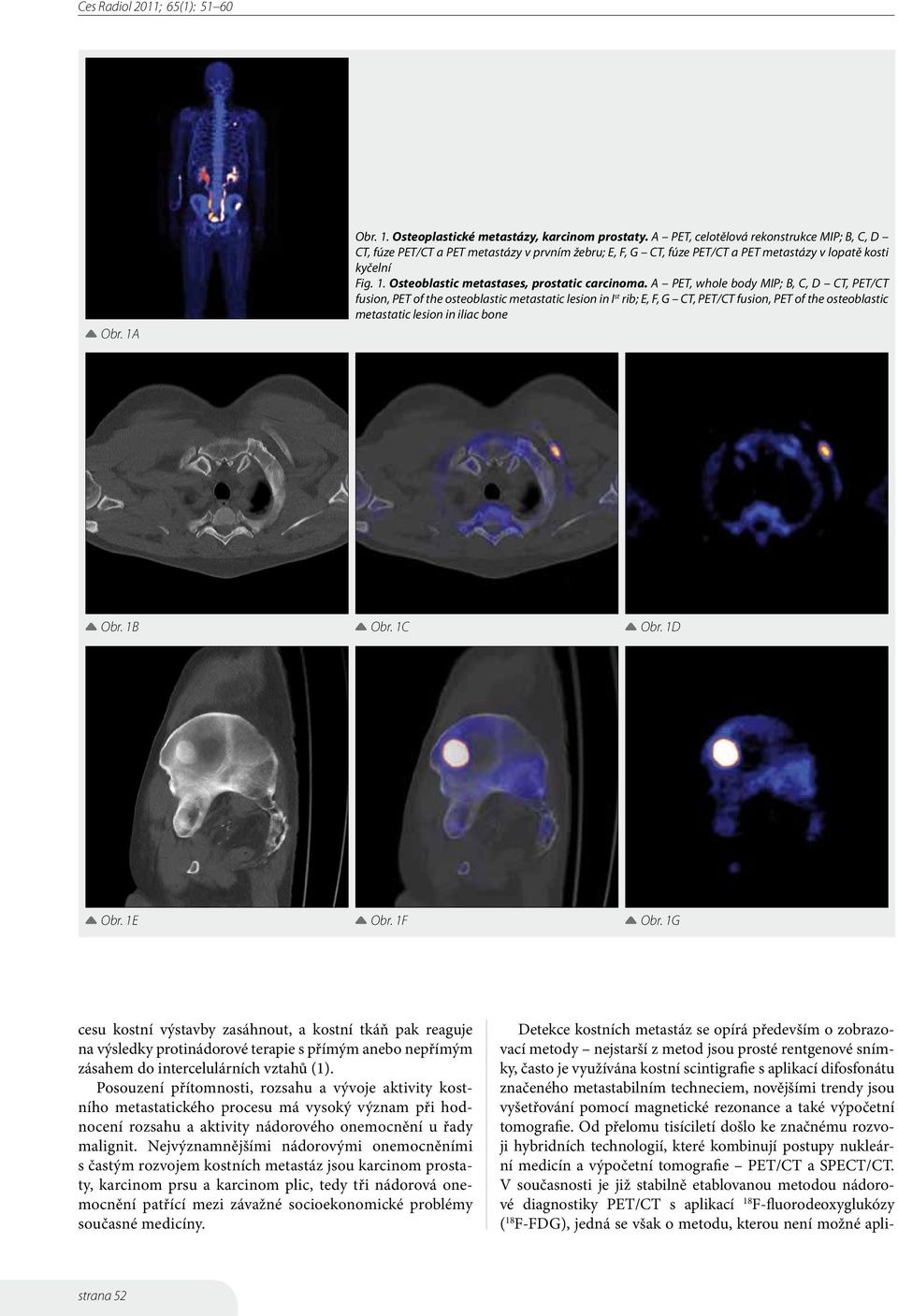 Osteoblastic metastases, prostatic carcinoma.