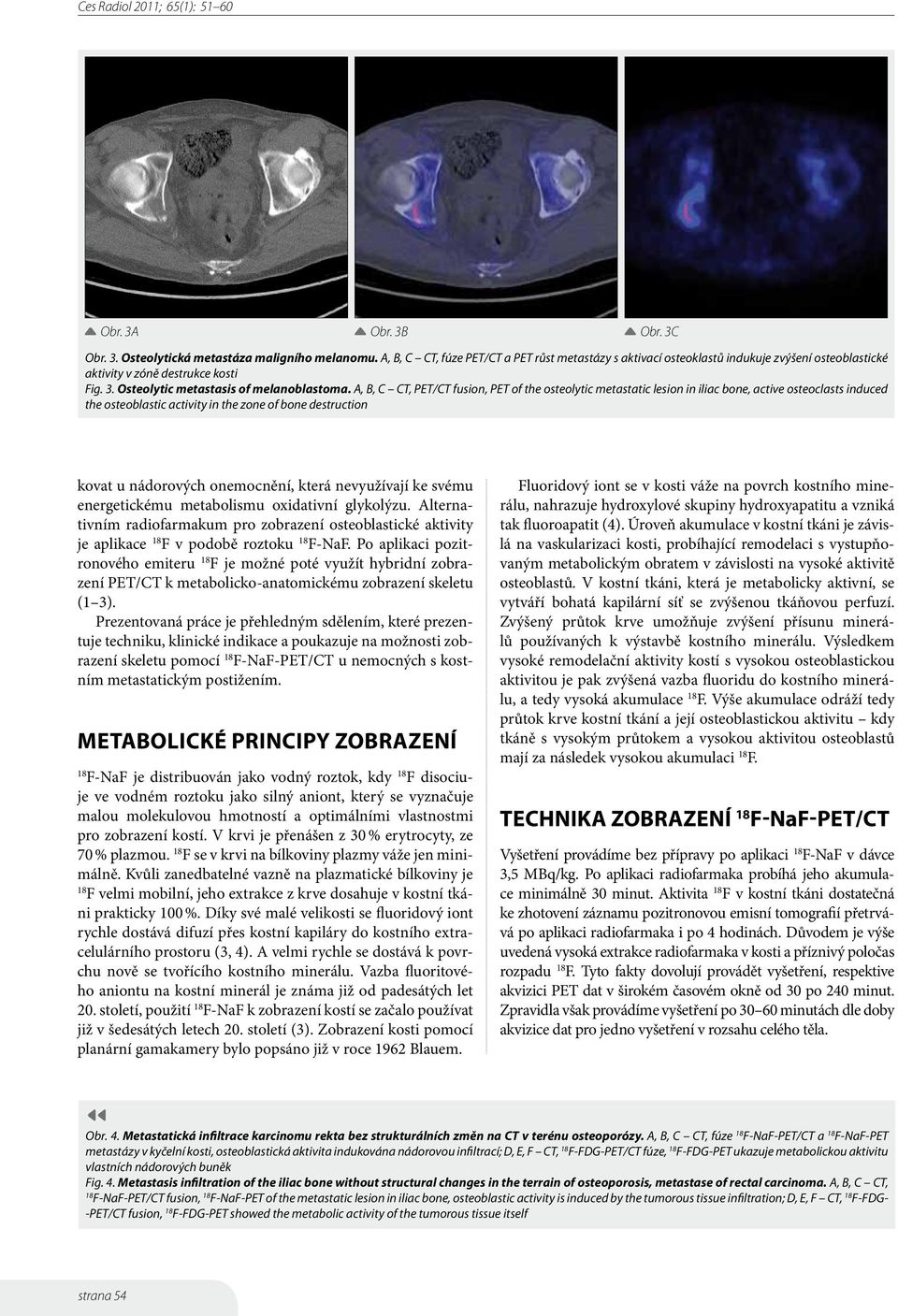 A, B, C CT, PET/CT fusion, PET of the osteolytic metastatic lesion in iliac bone, active osteoclasts induced the osteoblastic activity in the zone of bone destruction kovat u nádorových onemocnění,