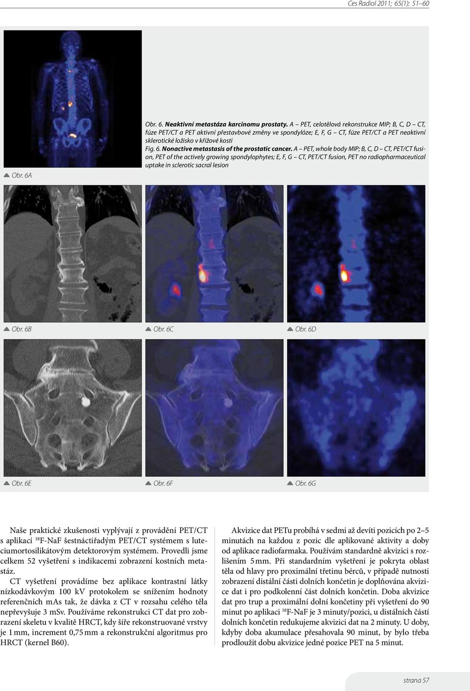 Nonactive metastasis of the prostatic cancer.