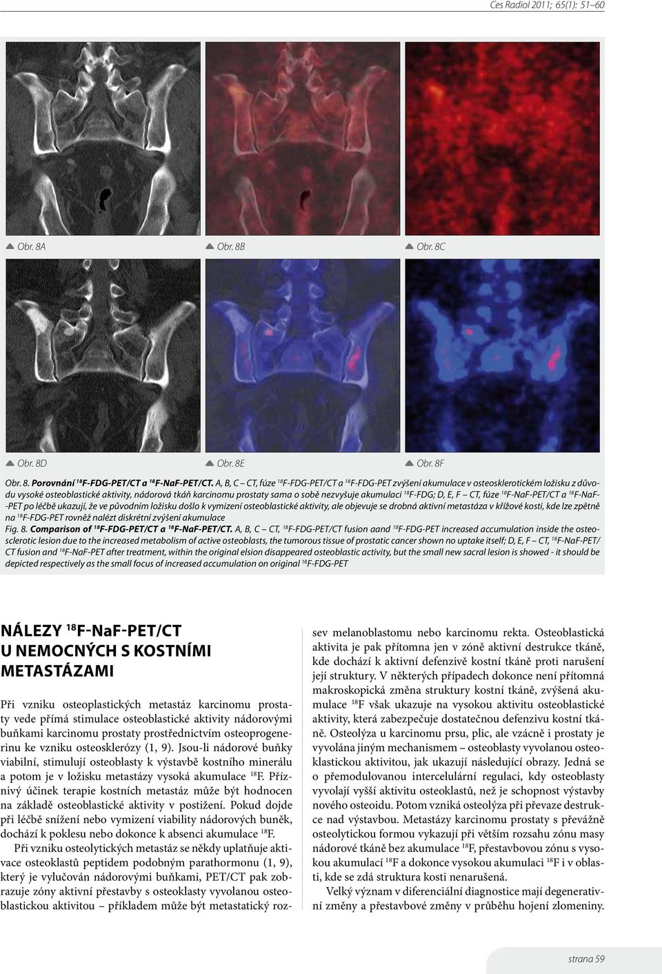 F-FDG; D, E, F CT, fúze F-NaF-PET/CT a F-NaF- -PET po léčbě ukazují, že ve původním ložisku došlo k vymizení osteoblastické aktivity, ale objevuje se drobná aktivní metastáza v křížové kosti, kde lze