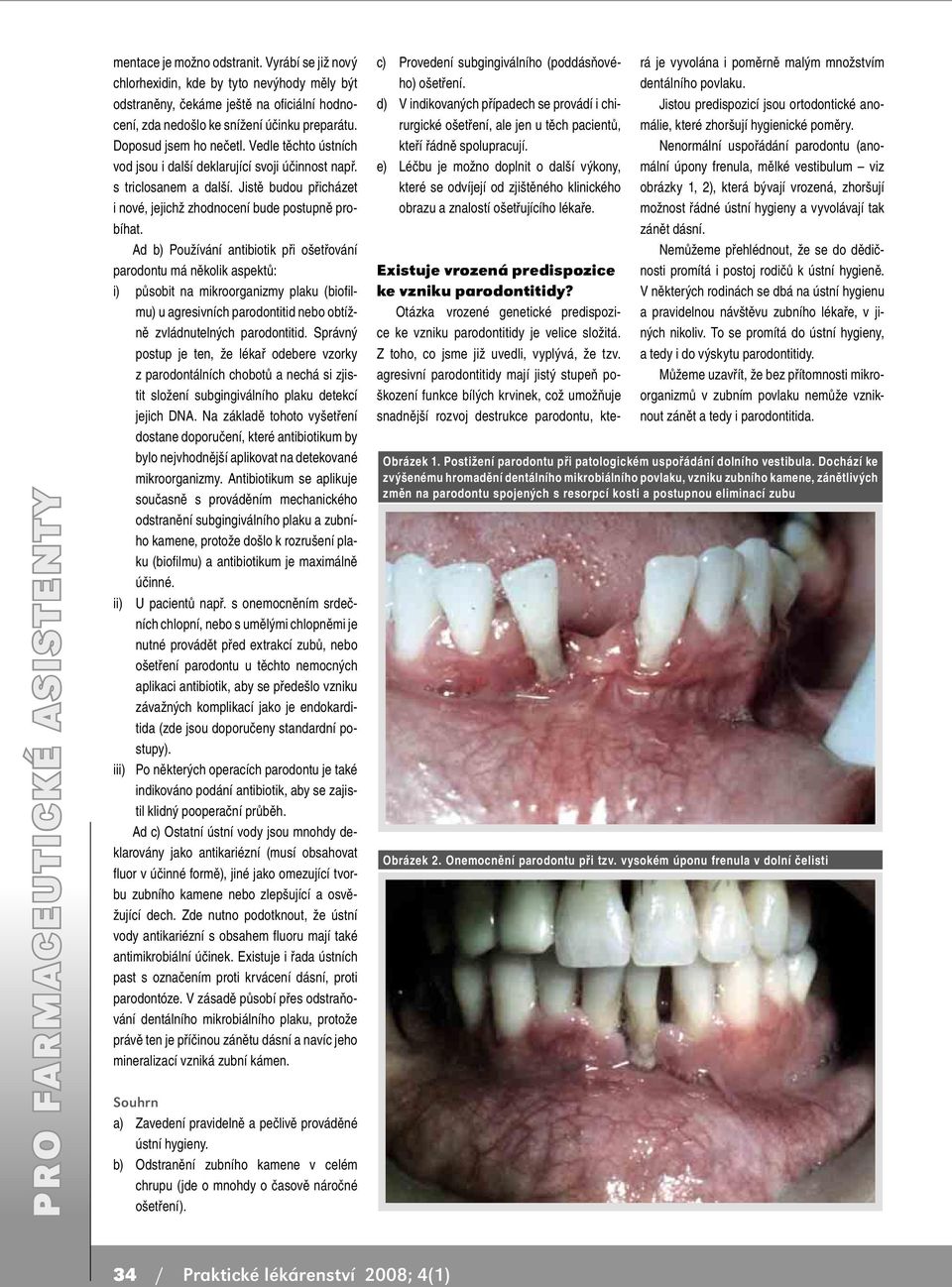 Ad b) Používání antibiotik při ošetřování parodontu má několik aspektů: i) působit na mikroorganizmy plaku (biofilmu) u agresivních parodontitid nebo obtížně zvládnutelných parodontitid.