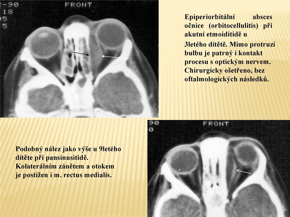 Chirurgicky ošetřeno, bez oftalmologických následků.