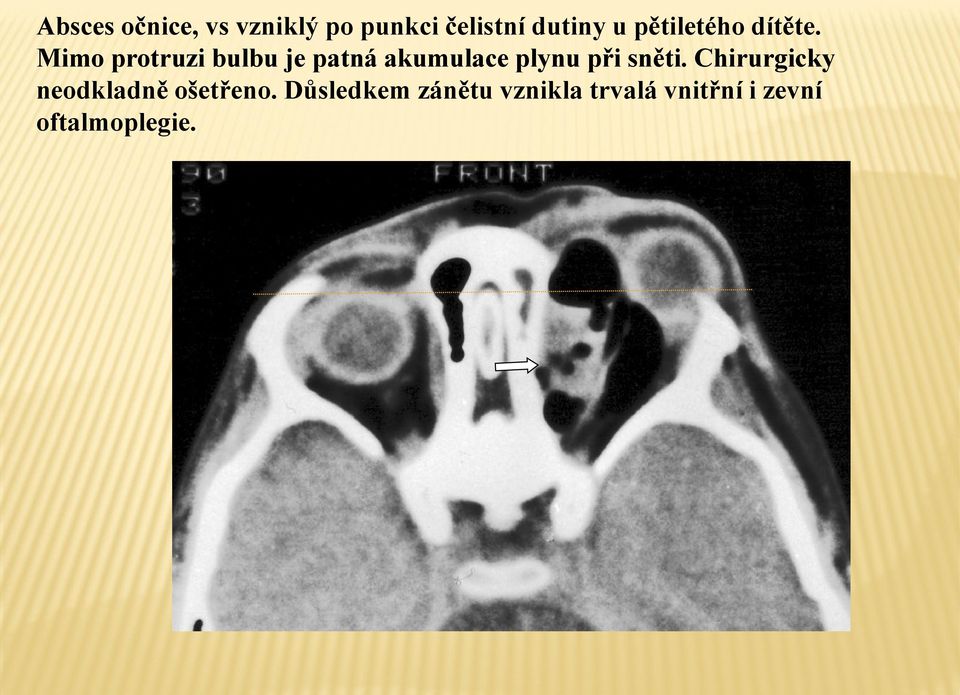 Mimo protruzi bulbu je patná akumulace plynu při sněti.