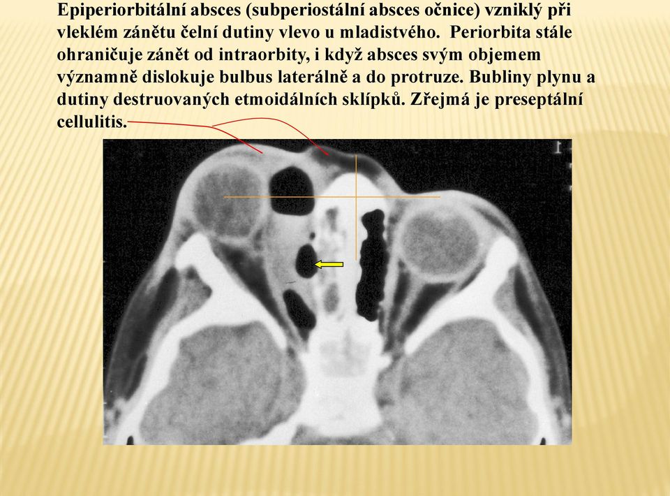 Periorbita stále ohraničuje zánět od intraorbity, i když absces svým objemem