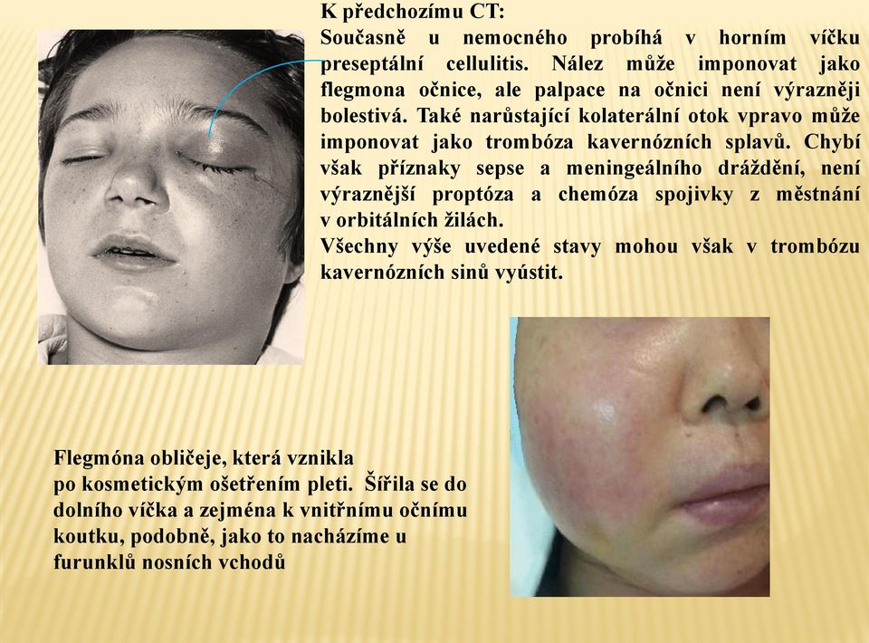 v horním víčku preseptální cellulitis. Nález může imponovat jako flegmona očnice, ale palpace na očnici není výrazněji bolestivá.