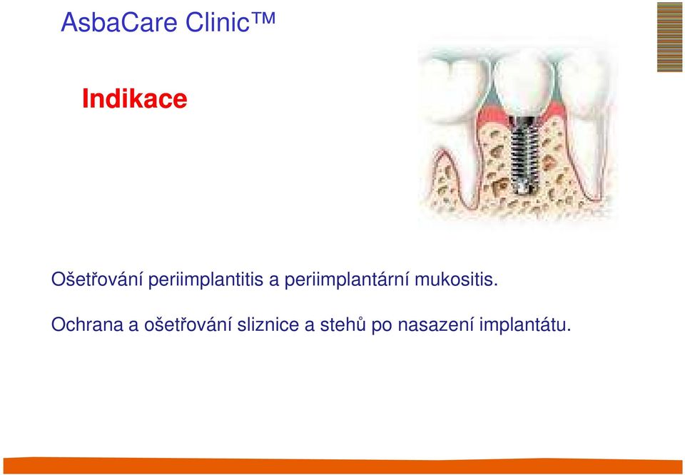 periimplantární mukositis.