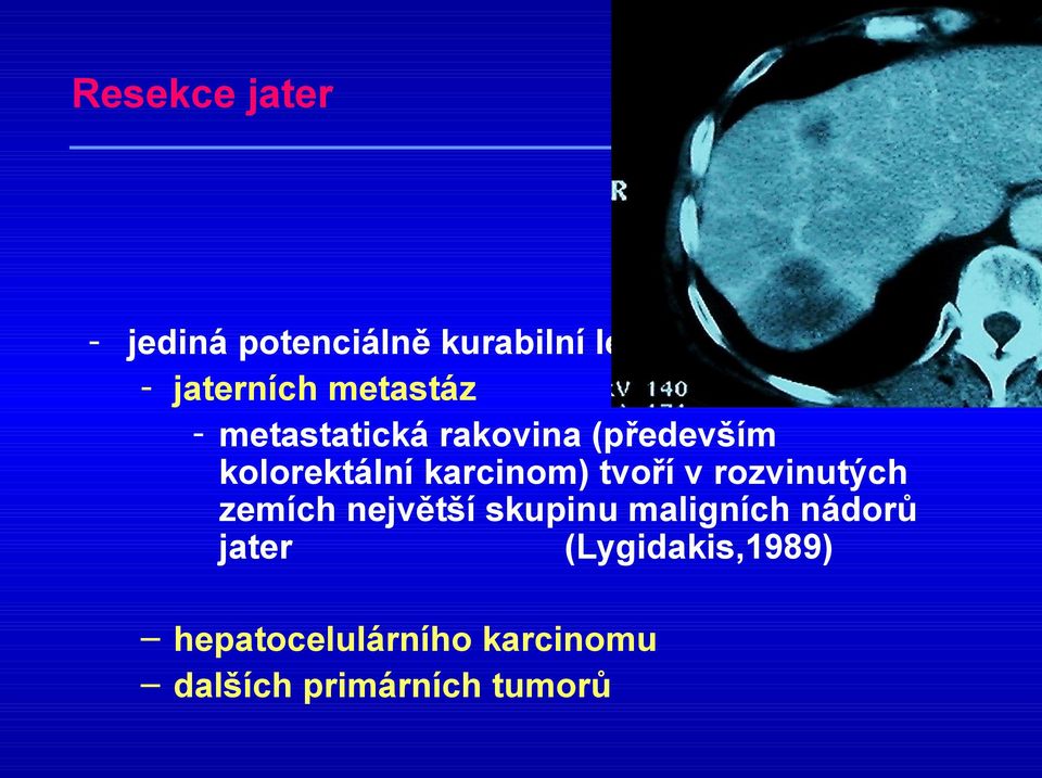 tvoří v rozvinutých zemích největší skupinu maligních nádorů jater