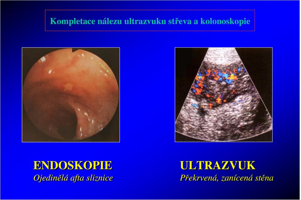 ENDOSKOPIE Ojedinělá afta