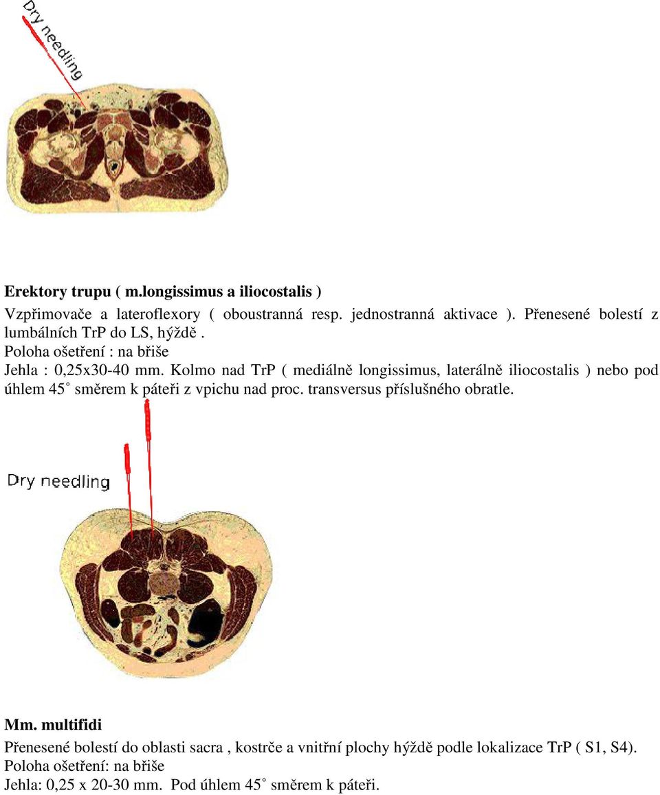 Kolmo nad TrP ( mediálně longissimus, laterálně iliocostalis ) nebo pod úhlem 45 směrem k páteři z vpichu nad proc.