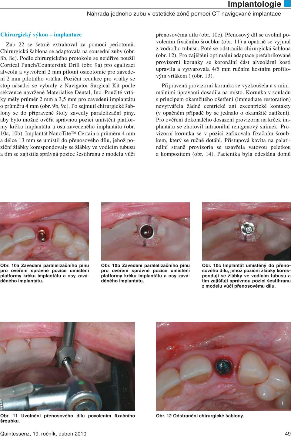 Poziční redukce pro vrtáky se stop-násadci se vybraly z Navigator Surgical Kit podle sekvence navržené Materialise Dental, Inc.