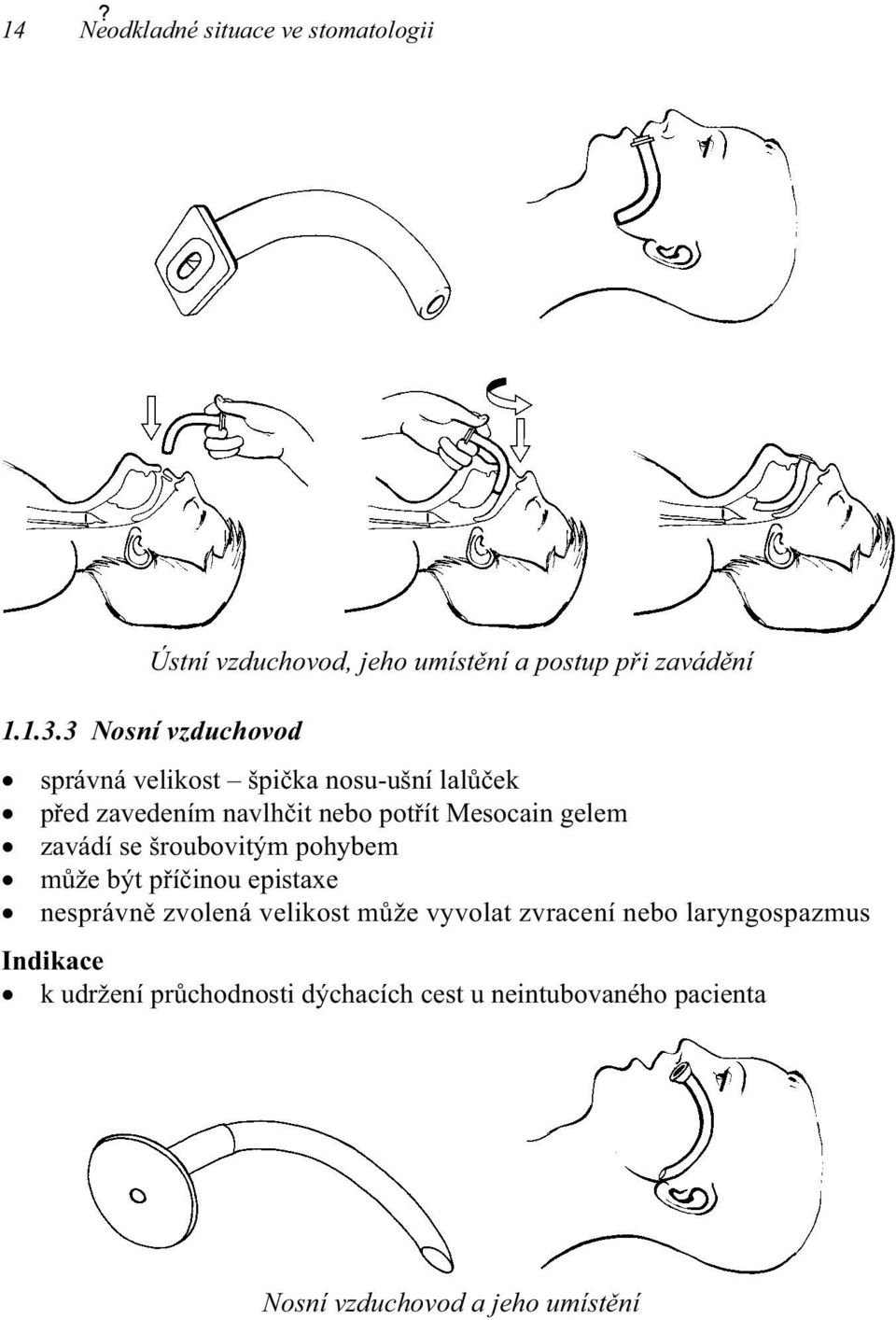 gelem zavádí se šroubovitým pohybem může být příčinou epistaxe nesprávně zvolená velikost může vyvolat