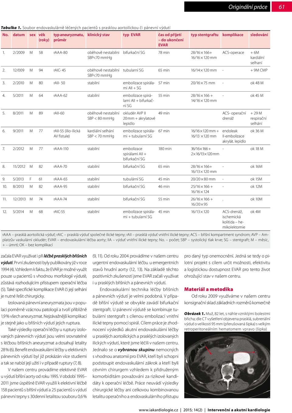 2/2010 M 80 raii- 50 stabilní embolizace spirálami AII + SG 4. 5/2011 M 64 raaa-62 stabilní embolizace spirálami AII + bifurkační SG 5. 8/2011 M 89 raii-60 oběhově nestabilní SBP < 80 mmhg 6.