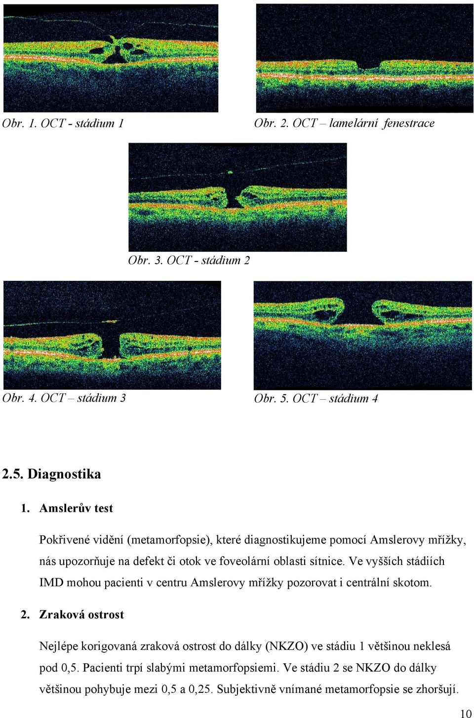 Ve vyšších stádiích IMD mohou pacienti v centru Amslerovy mřížky pozorovat i centrální skotom. 2.