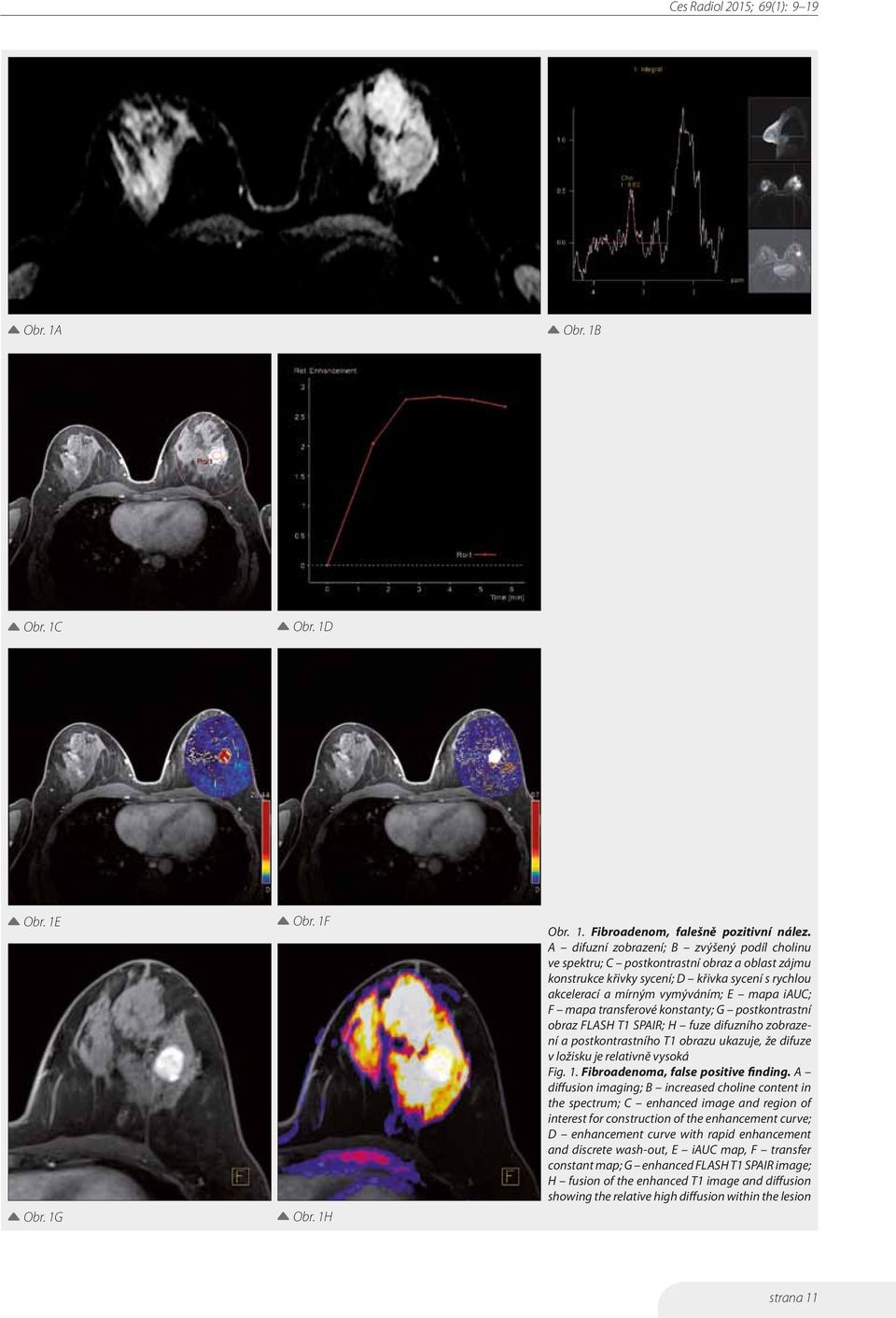 transferové konstanty; G postkontrastní obraz FLASH T1 SPAIR; H fuze difuzního zobrazení a postkontrastního T1 obrazu ukazuje, že difuze v ložisku je relativně vysoká Fig. 1.