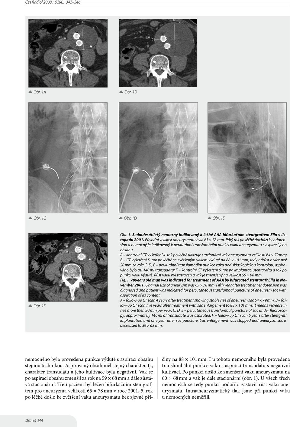 rok po léčbě ukazuje stacionární vak aneuryzmatu velikosti 64 79 mm; CT vyšetření 5.