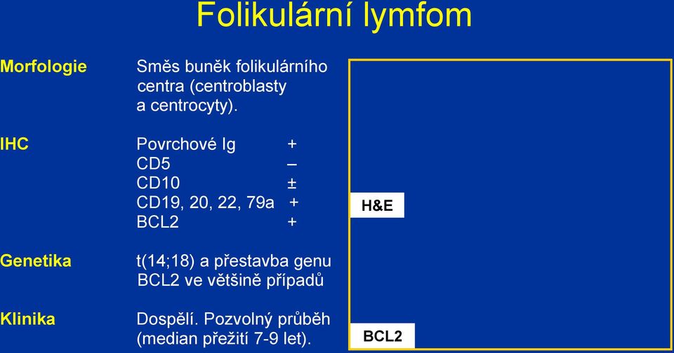 IHC Povrchové Ig + CD5 CD10 ± CD19, 20, 22, 79a + BCL2 + H&E