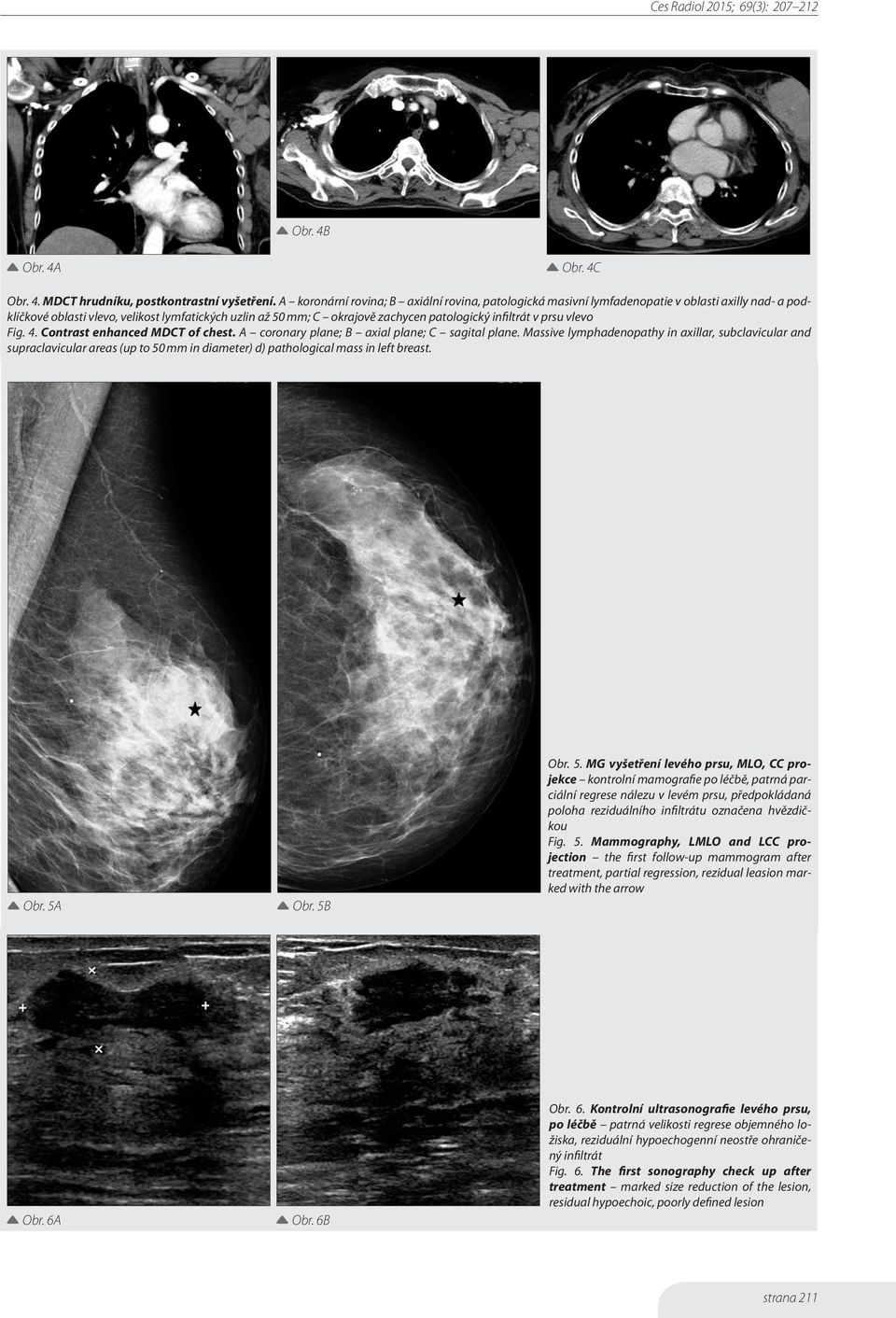 infiltrát v prsu vlevo Fig. 4. Contrast enhanced MDCT of chest. A coronary plane; B axial plane; C sagital plane.