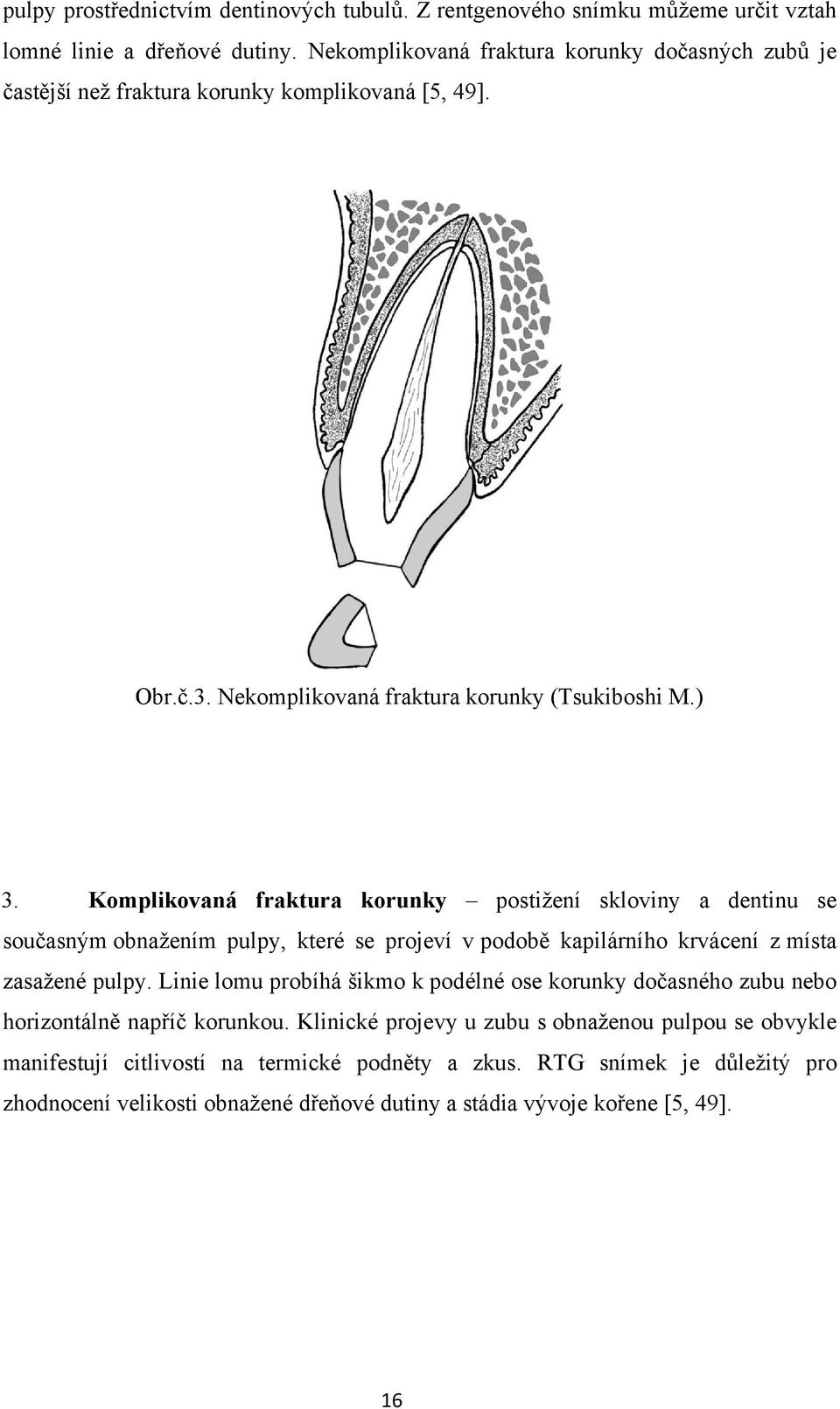 Komplikovaná fraktura korunky postižení skloviny a dentinu se současným obnažením pulpy, které se projeví v podobě kapilárního krvácení z místa zasažené pulpy.