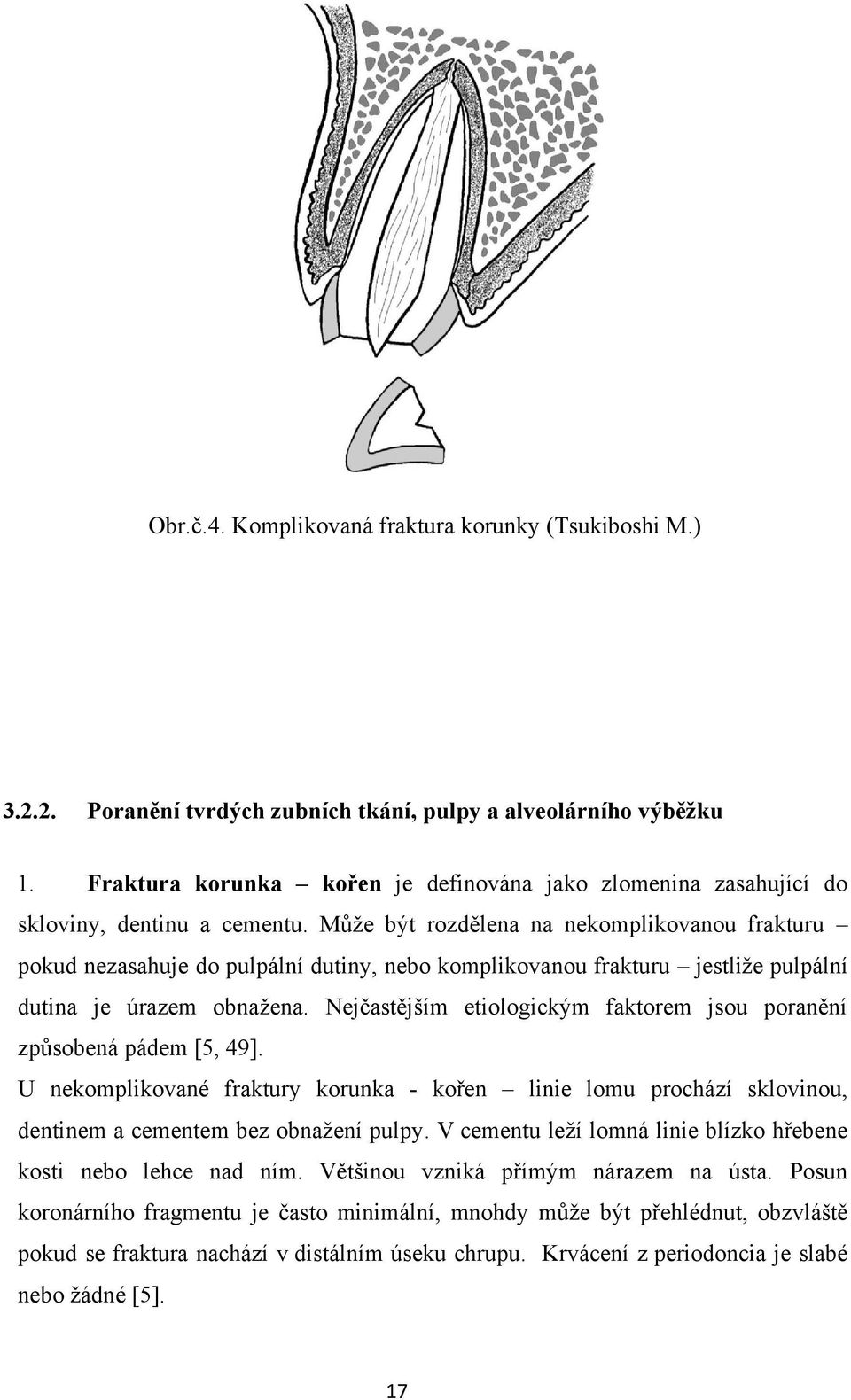 Může být rozdělena na nekomplikovanou frakturu pokud nezasahuje do pulpální dutiny, nebo komplikovanou frakturu jestliže pulpální dutina je úrazem obnažena.