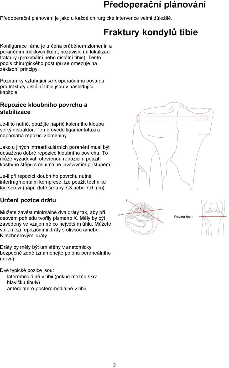 Tento popis chirurgického postupu se omezuje na základní principy. Poznámky vztahující se k operačnímu postupu pro fraktury distální tibie jsou v následující kapitole.