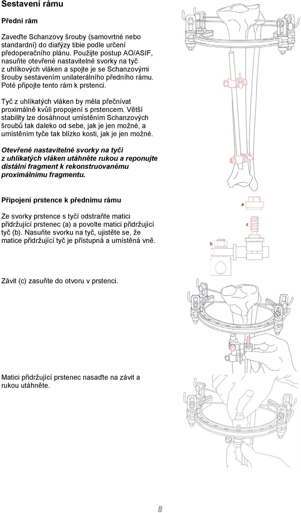 Tyč z uhlíkatých vláken by měla přečnívat proximálně kvůli propojení s prstencem.