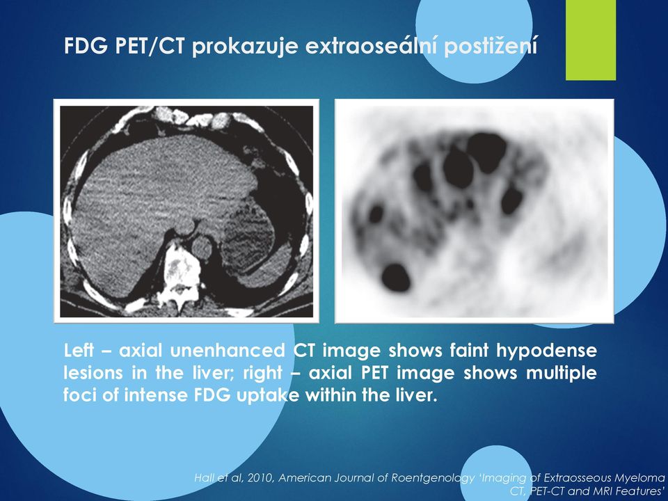 multiple foci of intense FDG uptake within the liver.