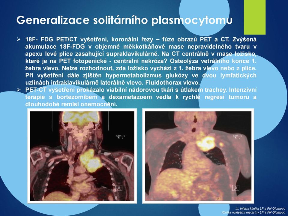 Na CT centrálně v mase ložisko, které je na PET fotopenické - centrální nekróza? Osteolýza vetrálního konce 1. žebra vlevo. Nelze rozhodnout, zda ložisko vychází z 1. žebra vlevo nebo z plíce.